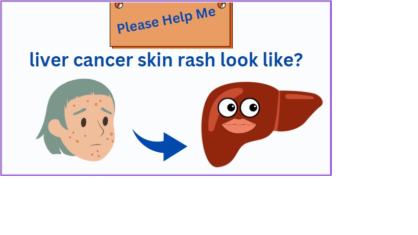 liver cancer skin rash