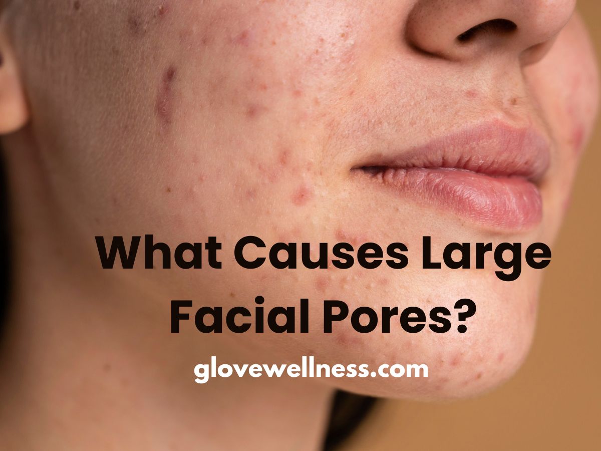 What causes large facial pores